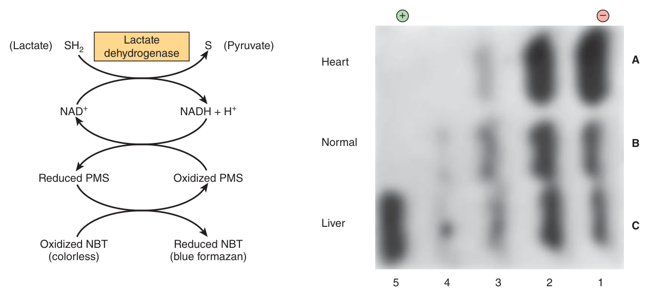 Normal and pathological patterns of LDH isozymes — the tissue of origin is inferred from the pattern, LDH-1 marking heart and LDH-5 liver