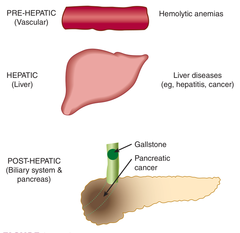 The three anatomical categories of jaundice: prehepatic (haemolysis), hepatic (hepatitis, cancer) and posthepatic (gallstone, cancer of the head of the pancreas)