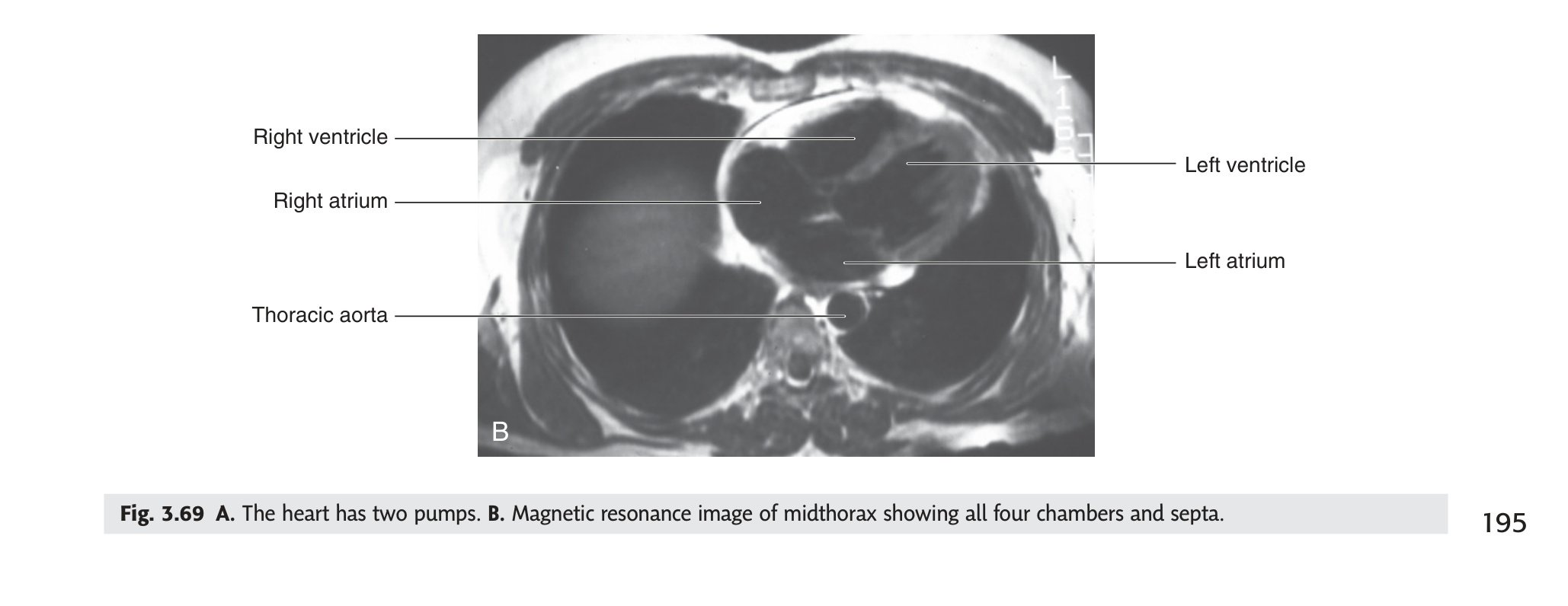 MRI midthorax – all 4 cardiac chambers (Gray's Fig 3.69B)