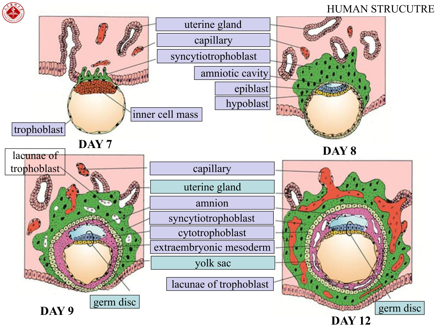Implantation with bilaminar disc
