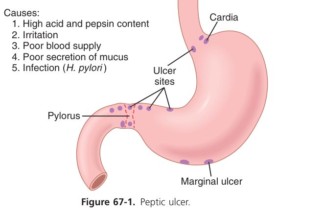 Peptic ulcer (Guyton Fig 67-1)