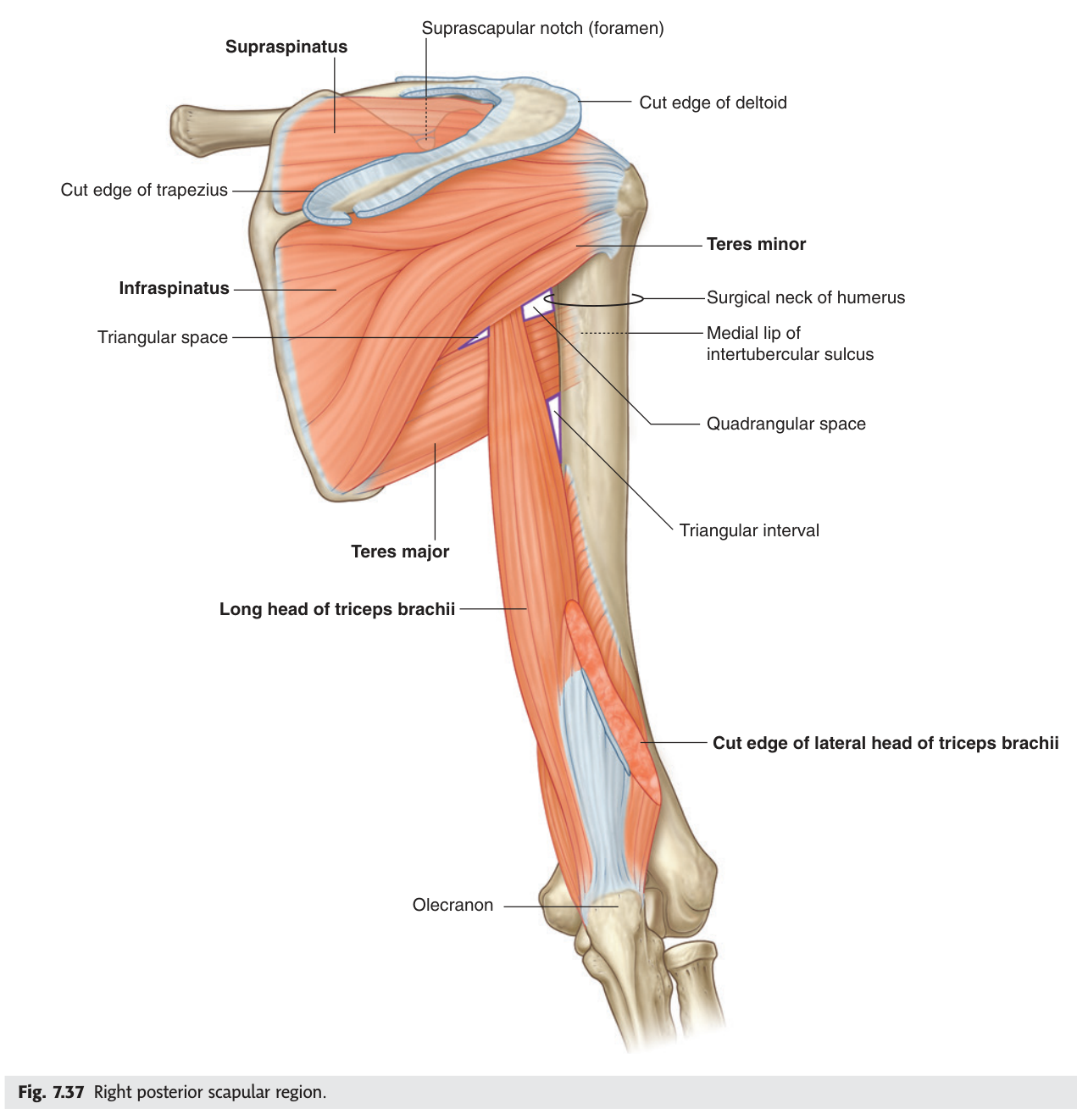 The right posterior scapular region with deltoid and the lateral head of triceps reflected, showing both spaces and the triangular interval below.