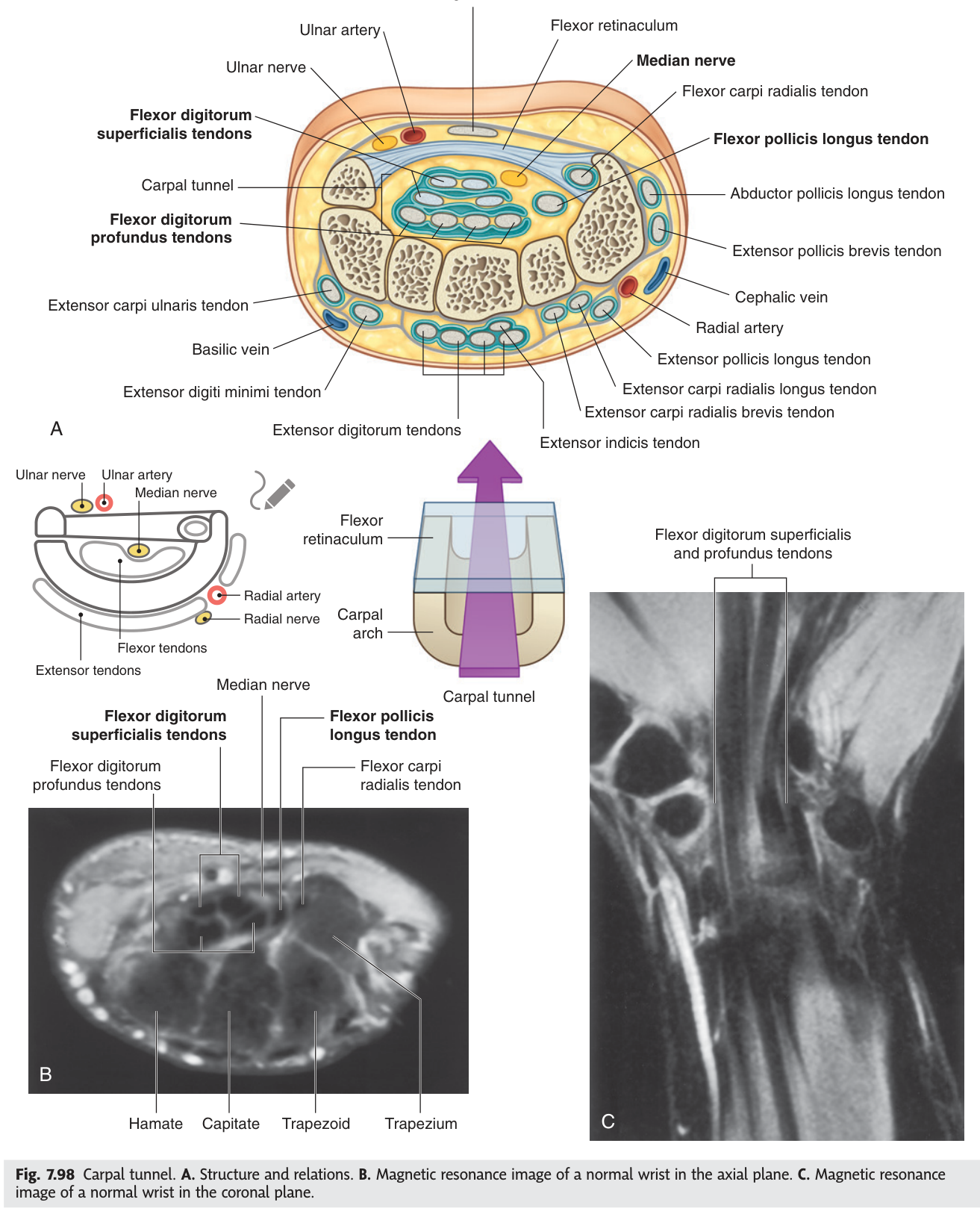 The carpal tunnel in cross-section, with the flexor retinaculum as its roof and the median nerve lying immediately beneath it.