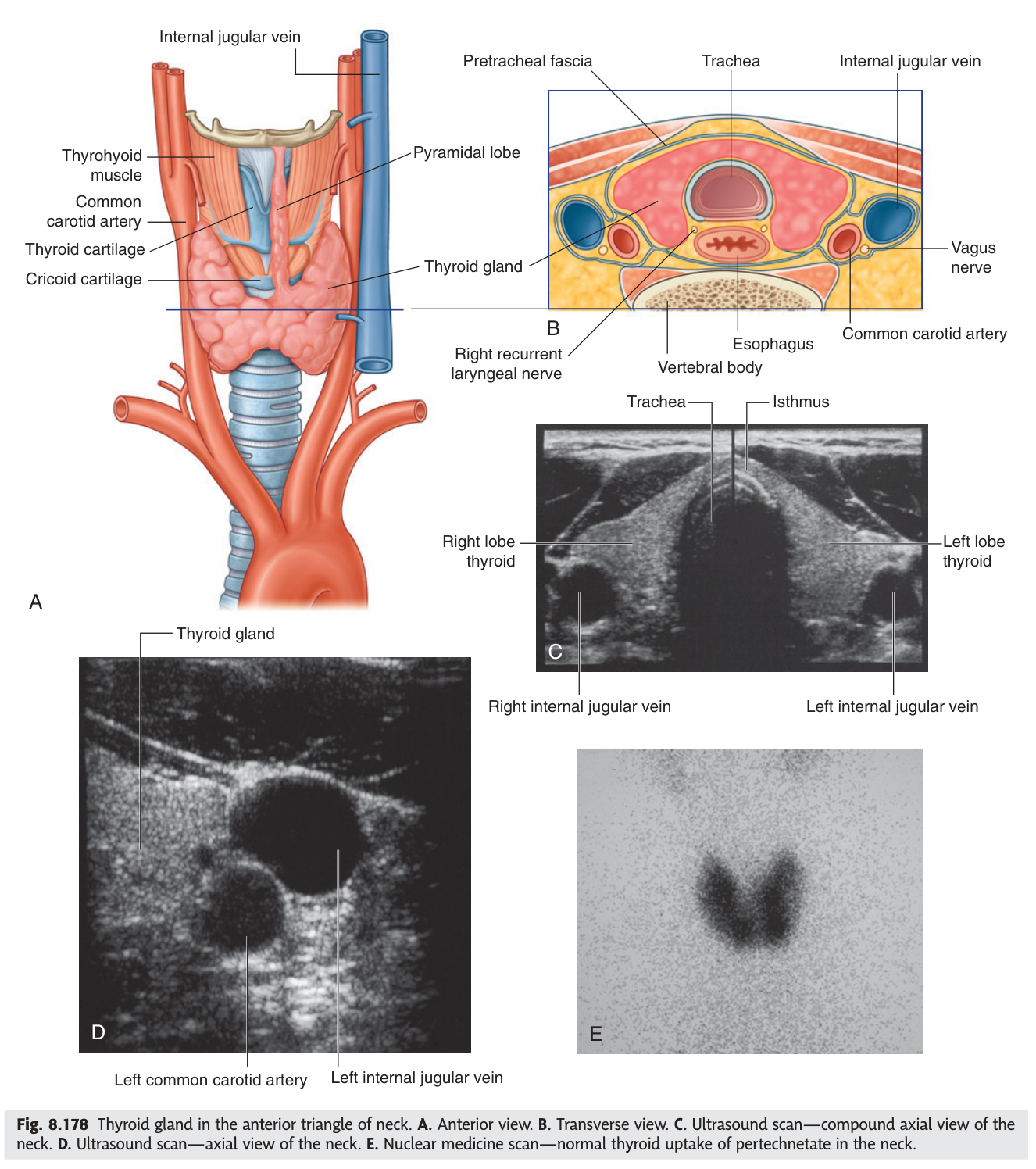 The thyroid gland in the anterior triangle of the neck. A. Anterior view. B. Transverse section showing its relation to the trachea, oesophagus and carotid sheath.