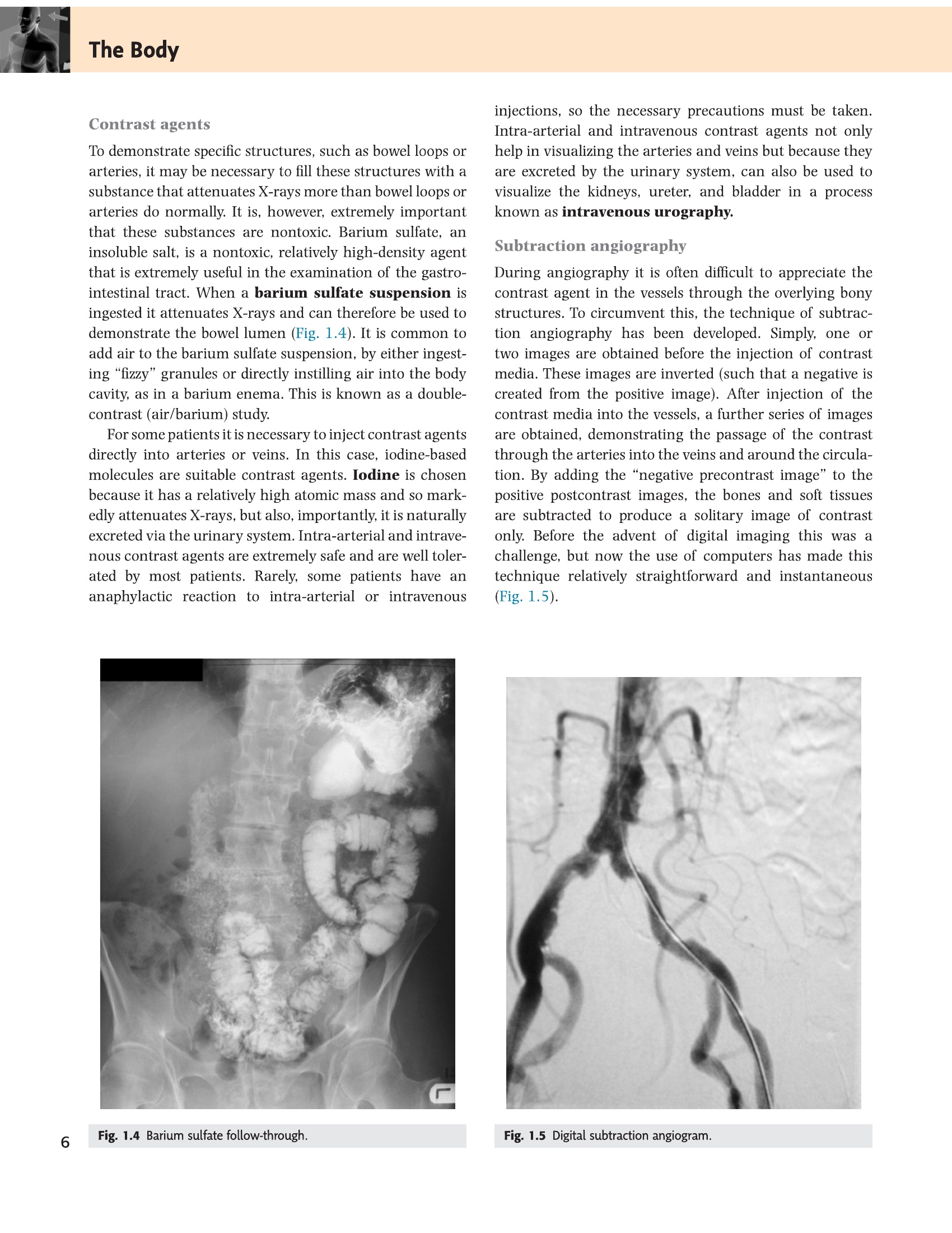 Fig 1.4-1.5 Barium follow-through and digital subtraction angiography
