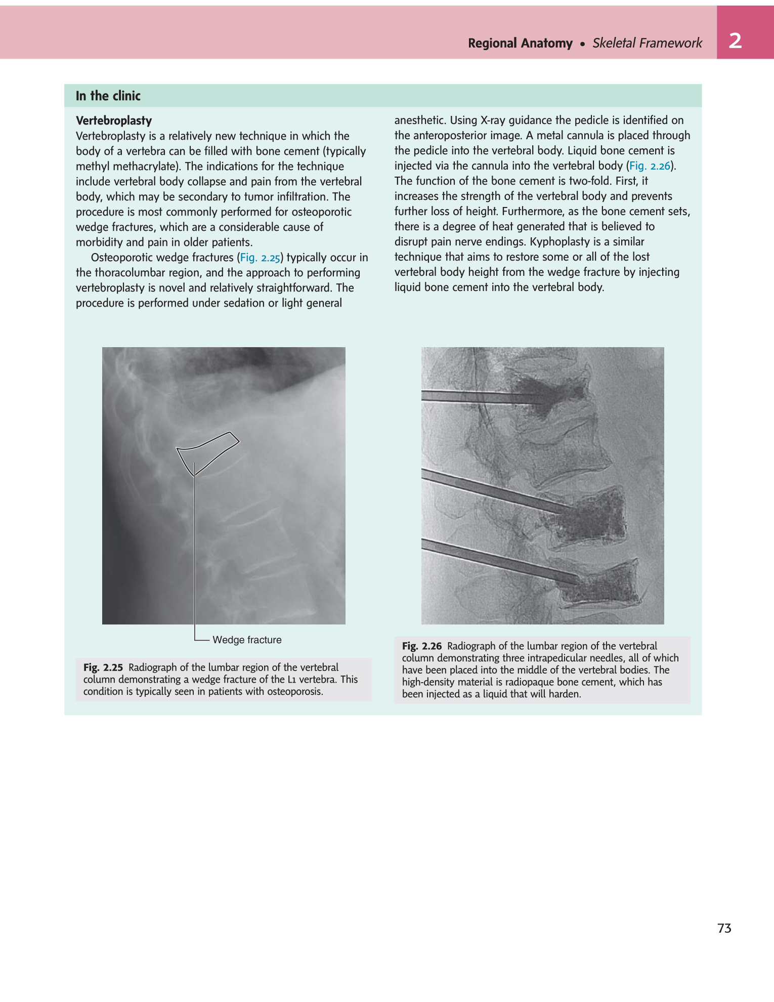 Figs 2.25-2.26 Vertebroplasty radiographs
