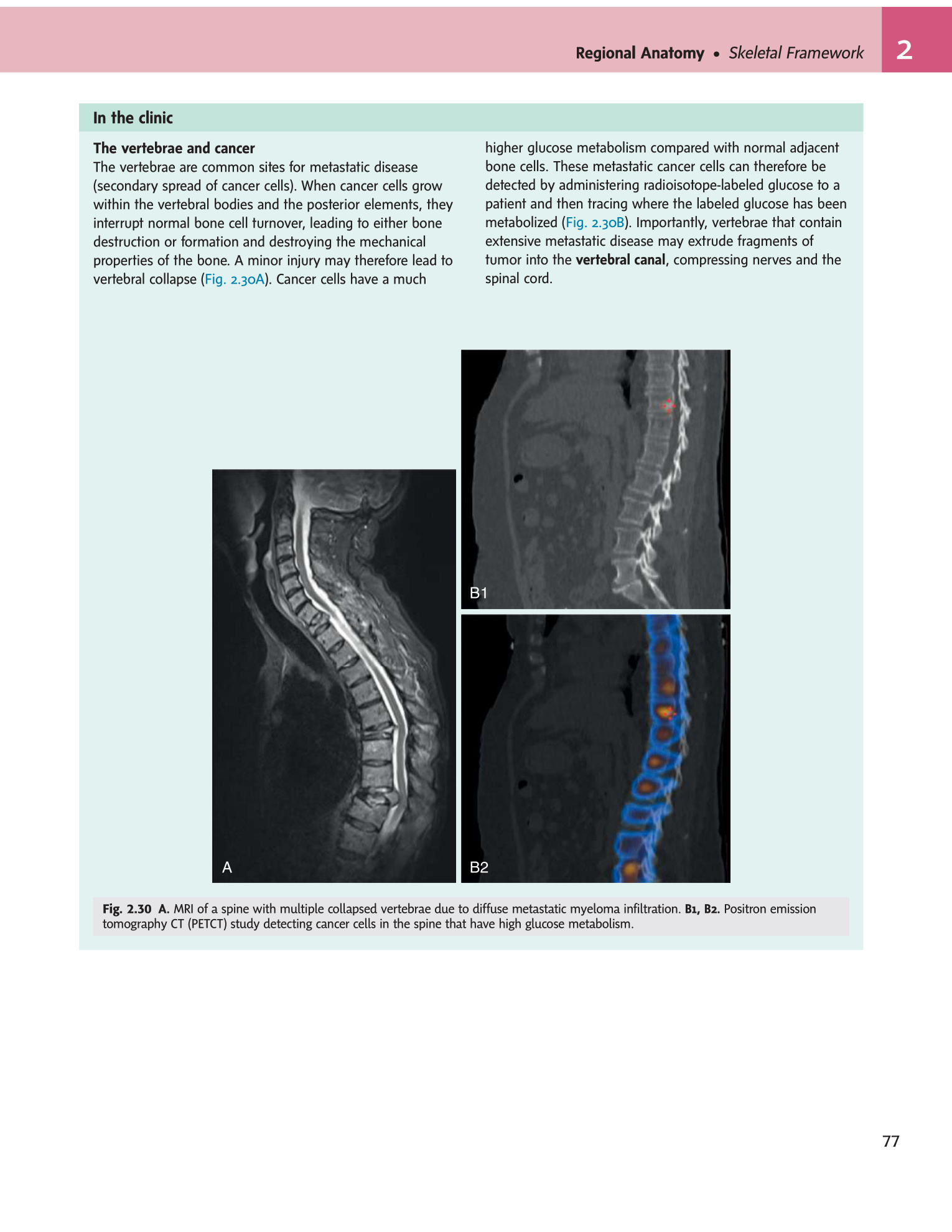 Fig 2.30 MRI and PETCT of spinal metastases