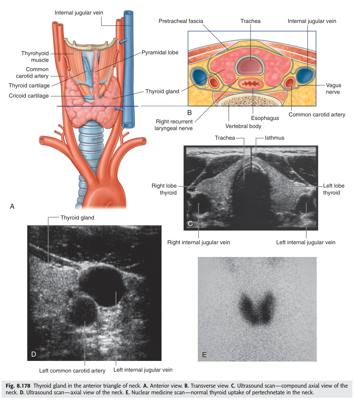 Thyroid gland in the anterior triangle of the neck
