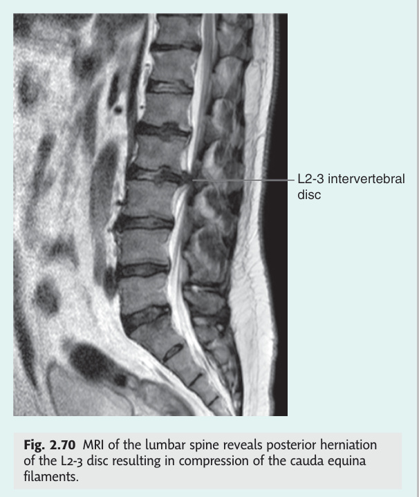 MRI of lumbar disc herniation compressing the cauda equina